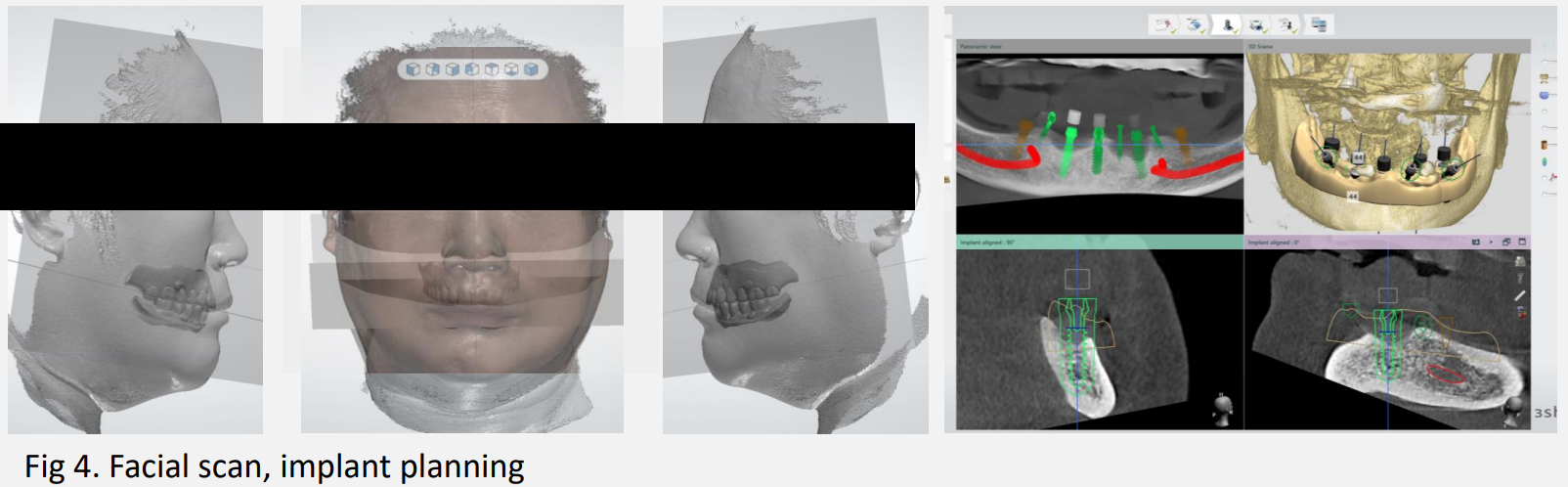 눈 부위를 가린 안모 스캔 세 컷과 정중선, 교합평면을 놓고 식립 위치를 잡은 계획 소프트웨어 화면