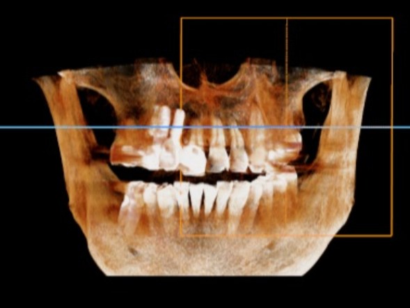 3D CT 진단 화면 — 잇몸병으로 치조골이 흡수되어 치아 뿌리가 드러난 상태